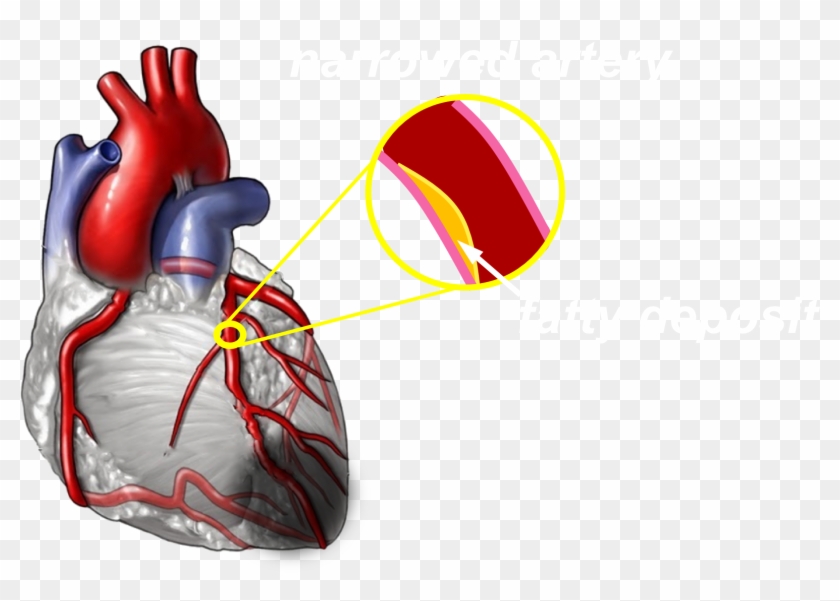 Less Pressure Is Generated By Hearts With Damaged Tissue - Coronary Artery Disease Png Clipart #5700013