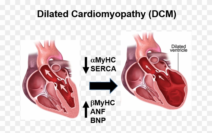 Figure 1 - Dilated Cardiomyopathy Clipart