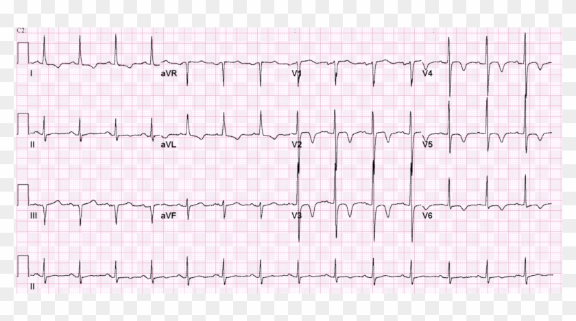 Cerebral T Waves - Neurogenic T Waves Clipart