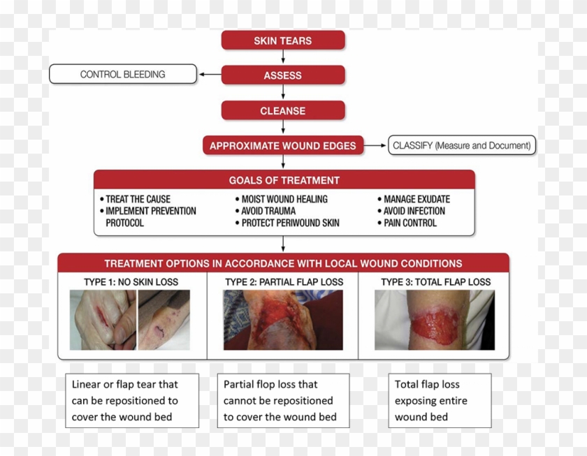 Decision Algorithm - Skin Tear Decision Algorithm Clipart