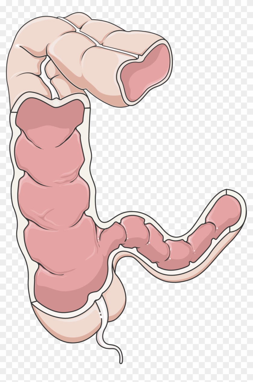 Download The Image - Crohn's Disease Png Clipart