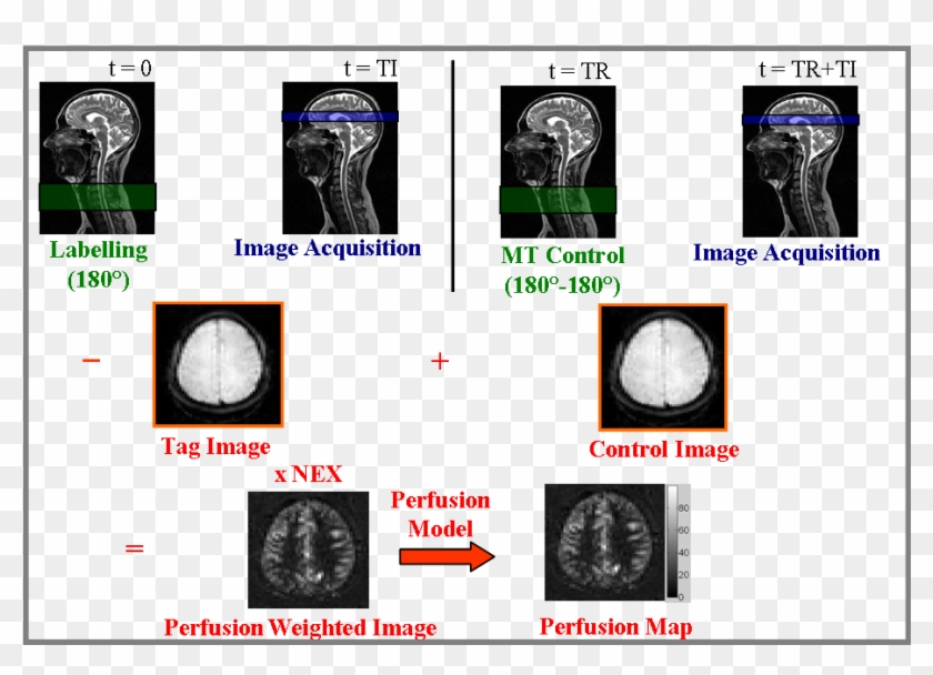 Arterial Spin Labeling-experiment - Normal Neck Mri Clipart