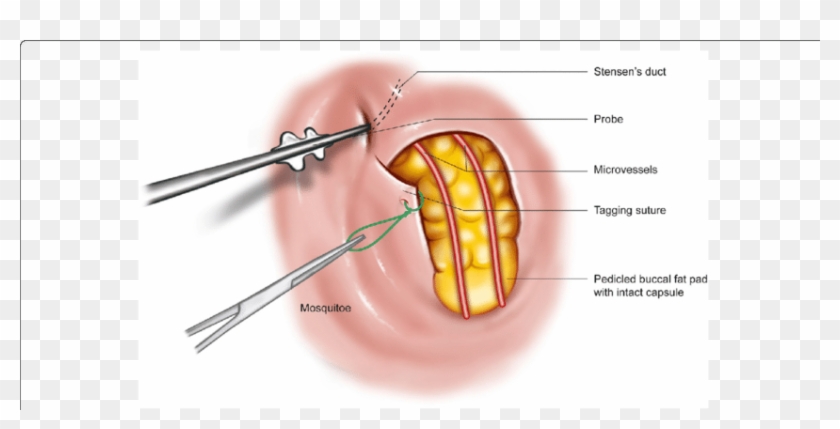 Blunt Transparent Fat - Herniation Of Buccal Fat Pad Clipart