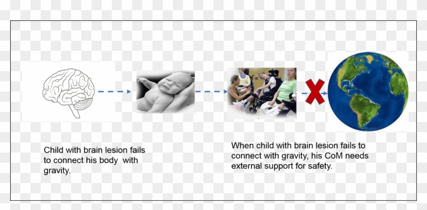 Child With Brain Lesion Can Not Connect To Gravity - Sphere Clipart #5825744