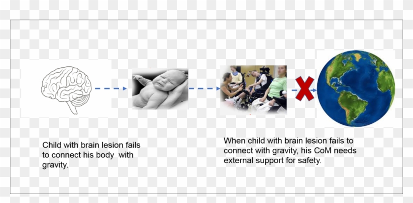Child With Brain Lesion Can Not Connect To Gravity - Sphere Clipart