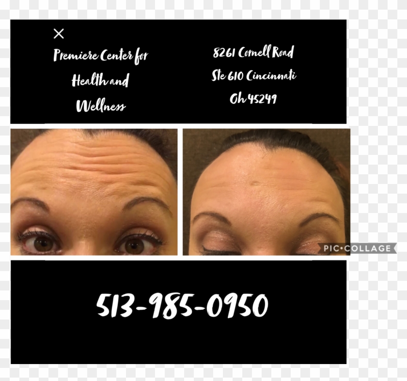 Premierecenters Botox Clipart #5854913
