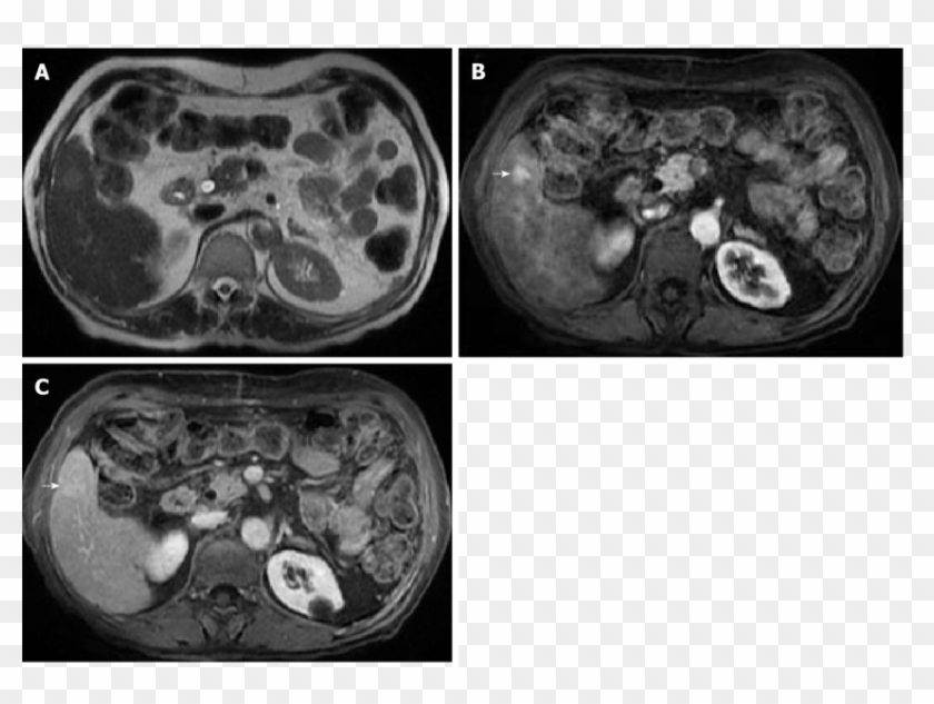 Fat Person Png - Radiology Clipart #5864824