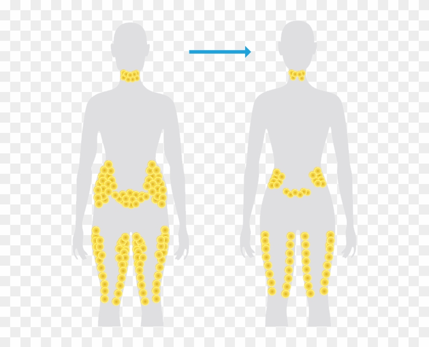 Coolsculpting® Fat Reduction - Unique Beauty And Laser Clinic Clipart #5866345