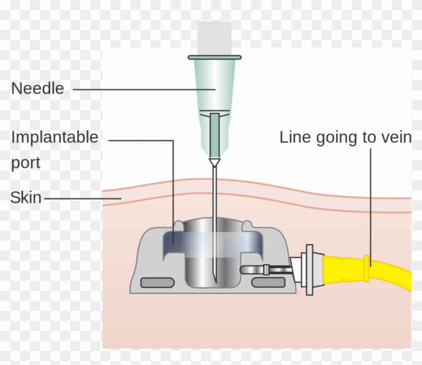 To Help Better Understand And Get A Visual Of What - Port A Cath Clipart