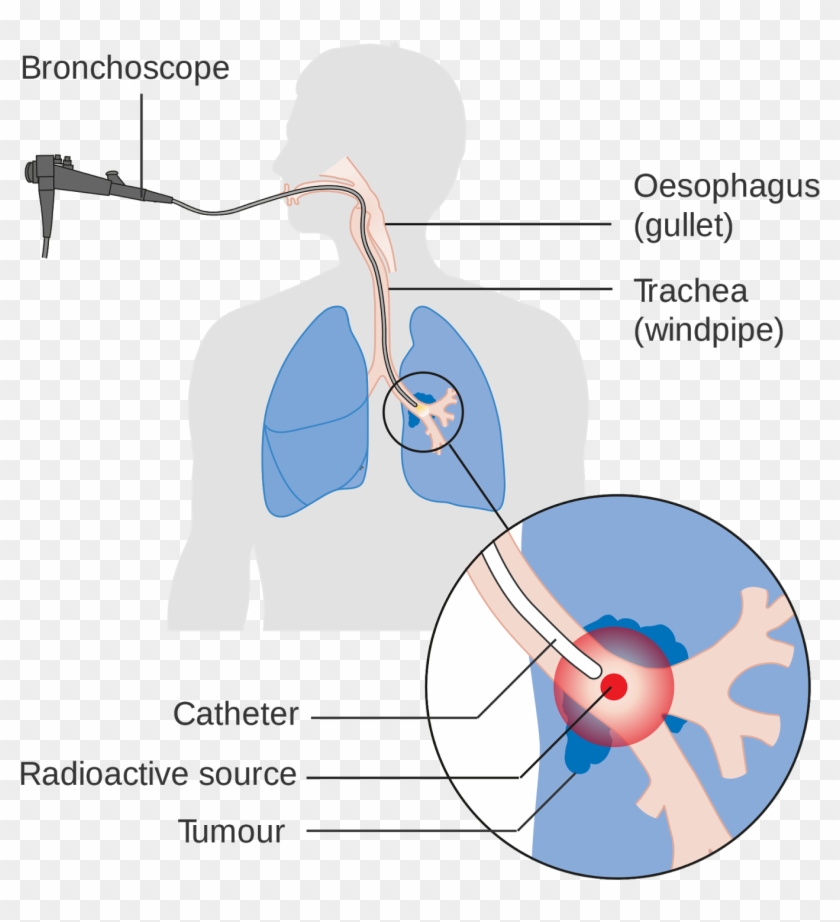 Radiation Therapy For Cancer Clipart