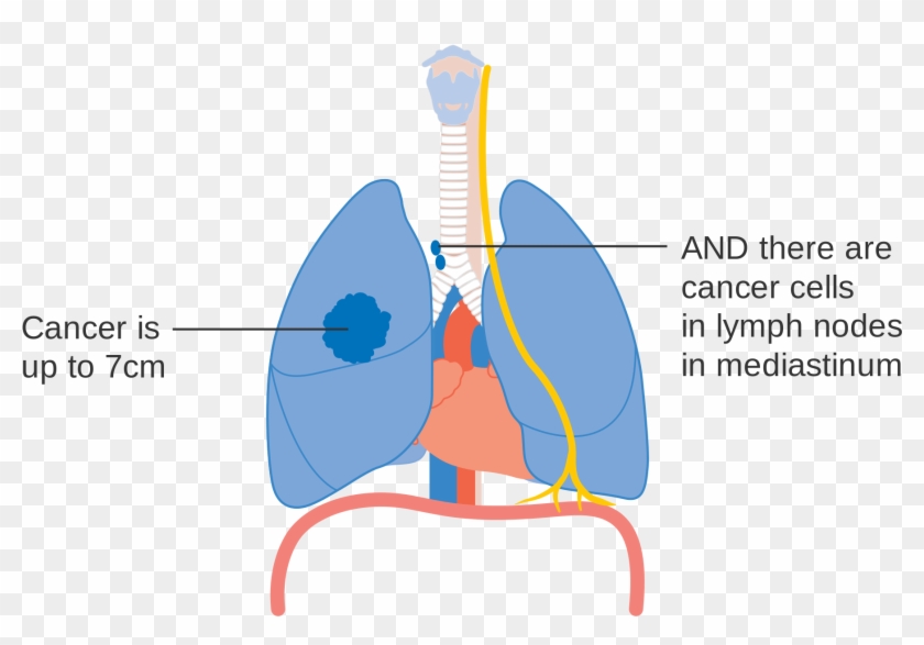 1 Of 3 Showing Stage 3a Lung Cancer Cruk - Stage 3b Lung Cancer 7 Cm Clipart #5926158