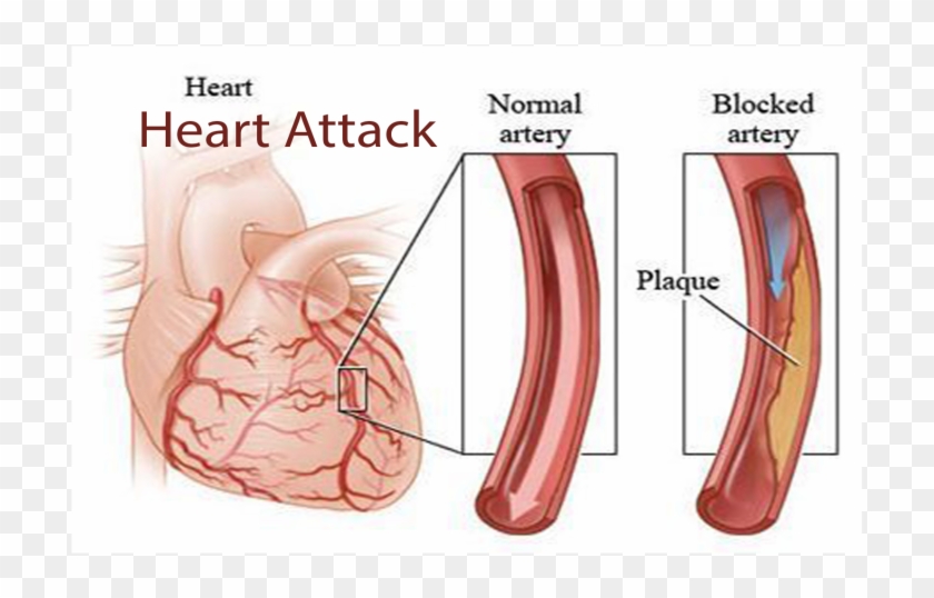 Coronary Angiography Clipart