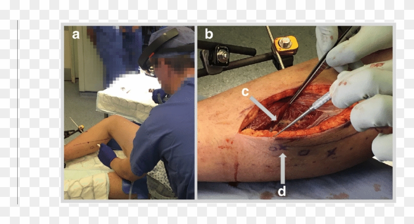 A Case 5 Marking Of Skin Under Hololens Guidance - Food Processing Clipart #5967817