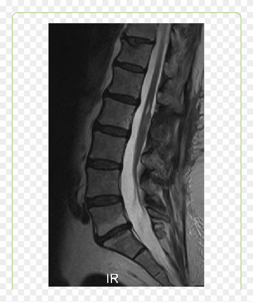 Sagittal T2 Weighted Mr Image 8 Months After Surgery - Medical Imaging Clipart
