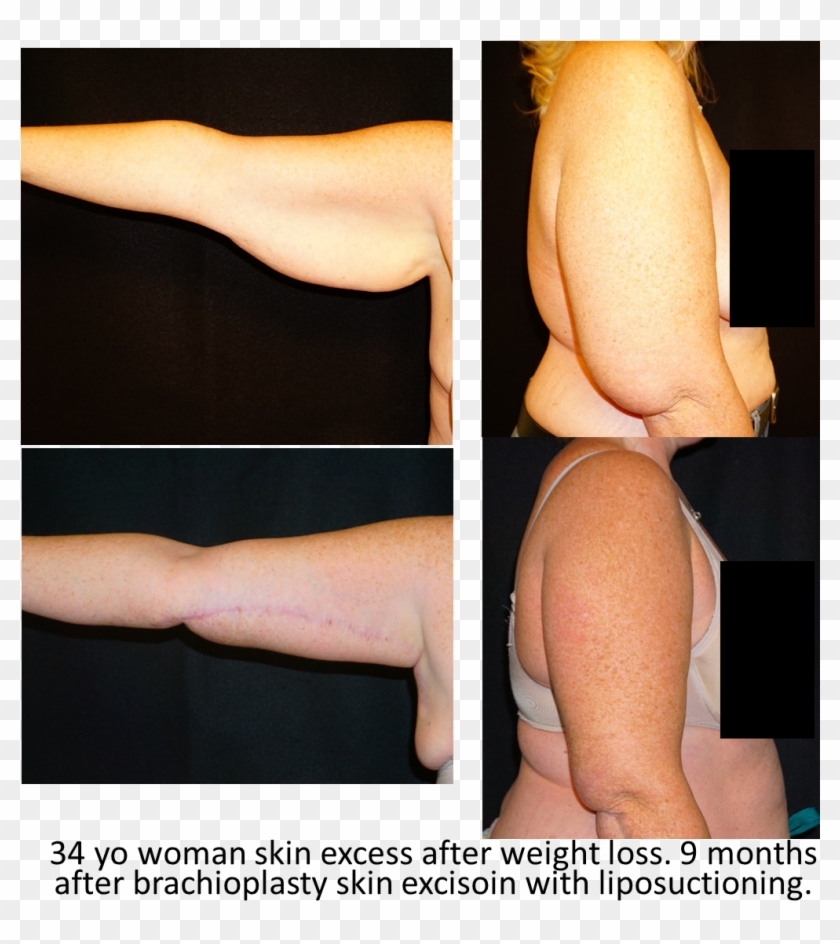 Arm Lift - Photo Caption Clipart