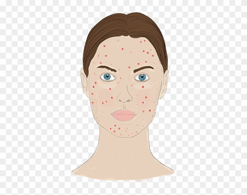 Acne Png - Illustration Clipart #6028791