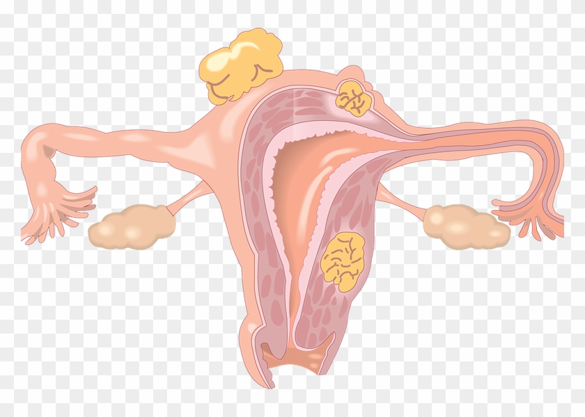 Free Childcare During Smear Tests In Amesbury - Fertility Disorder Clipart