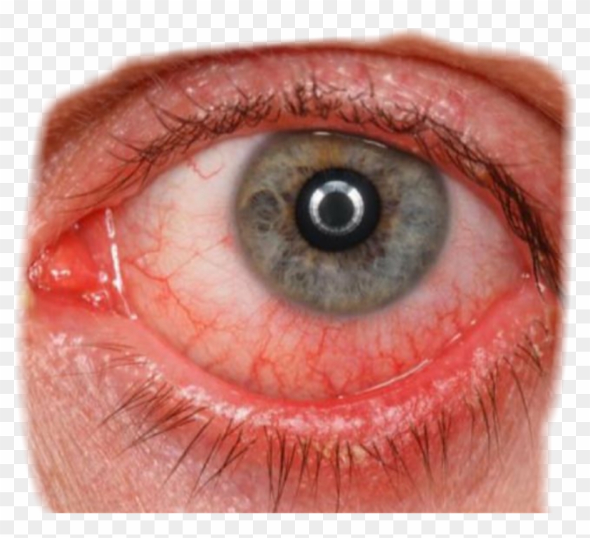 Eye Redeye Bloodshot Bloodshoteye Eyes Red - Симптом Повышенного Глазного Давления Clipart