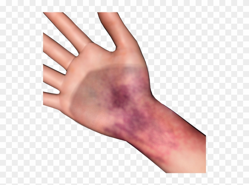 Bruise Png Clipart #641910