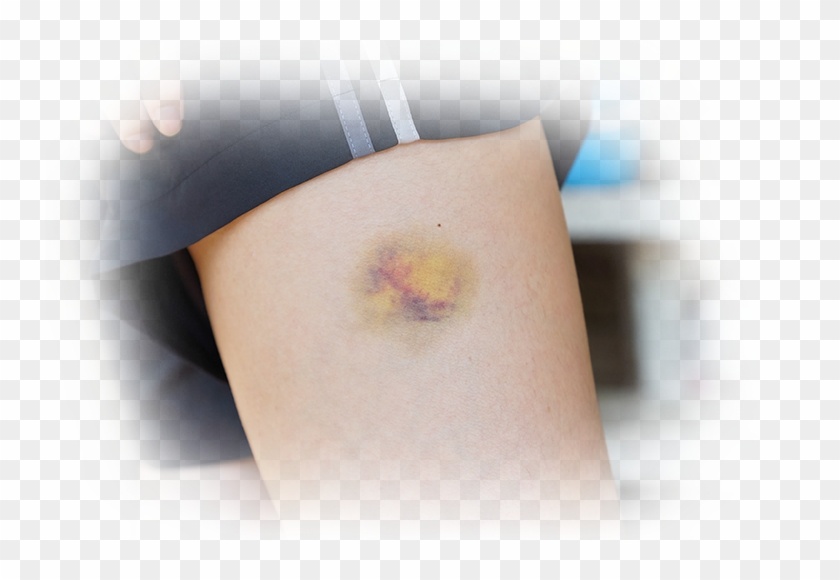 Sudden Unexplained Bruises - Cross Clipart #642004