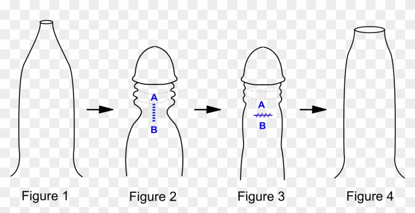 Preputioplasty Png Conv - Frenulum Breve Clipart