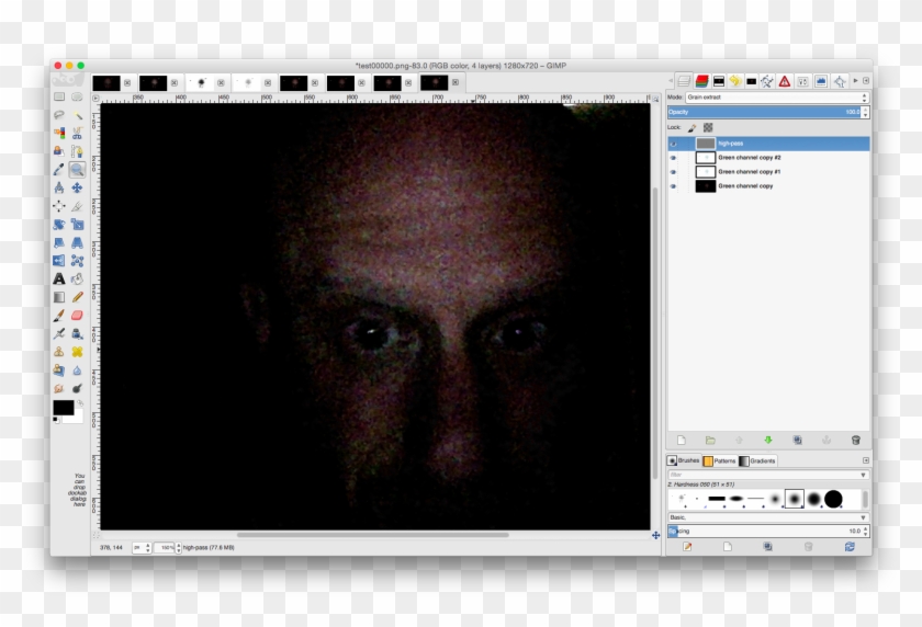 The Yellow "spokes" Around My Right Eye Are Sucker - Graphics Software Clipart