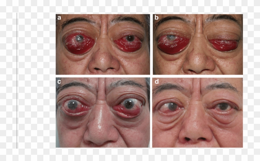 A 74 Year Old Man Developed Highly Active Ted With - Close-up Clipart