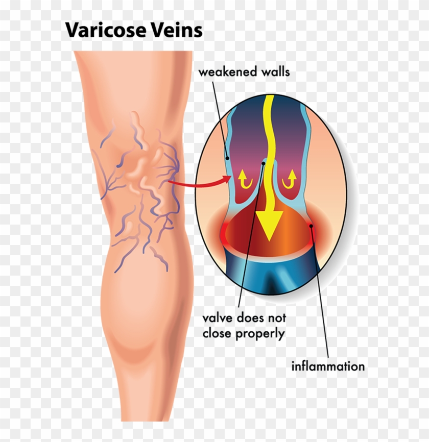 By Unsightly Veins Are Delighted With The Results They - One Way Valves Veins Clipart
