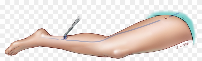 Treatment-vein Stripping - Leather Clipart #755914