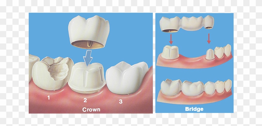 Dental Crowns And Bridges Clipart #765928
