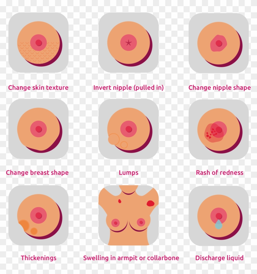 Nipple Discharge Or An Enlarged Underarm Lymph Node - Lumpy Nipple Clipart