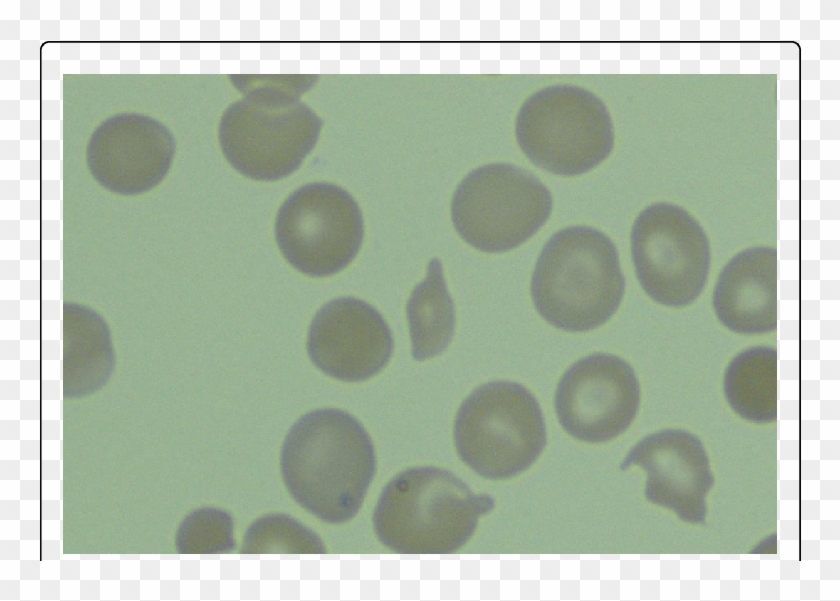 Peripheral Blood Smear With Schitocytosis - Circle Clipart #876865