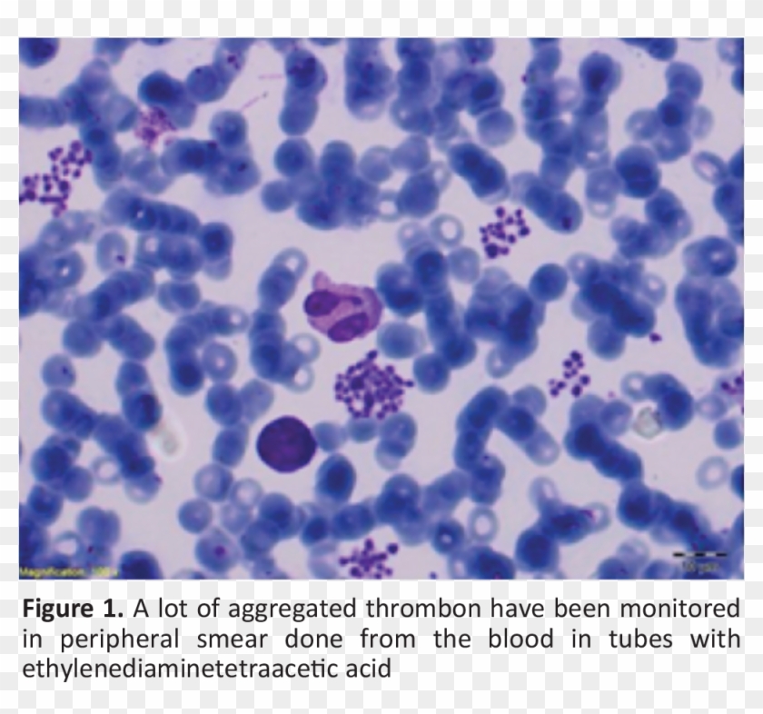 In The Patient For Whom Pseudothrombocytopenia Is Considered, - Poster Clipart #877506