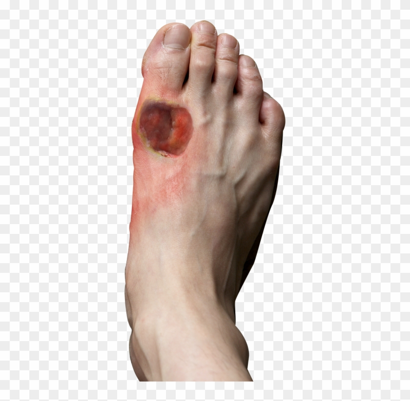 Signs And Symptoms Of Diabetic Foot - Chronic Wound Feet Clipart #888862