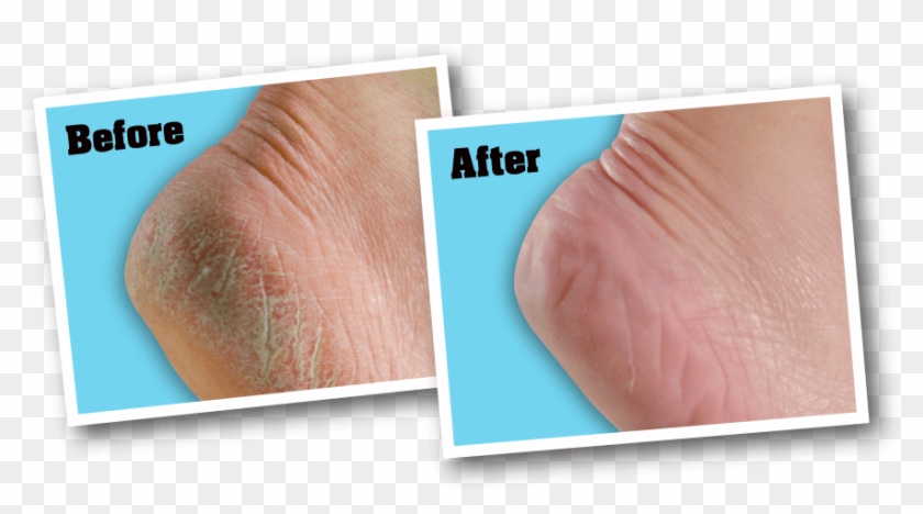 For Best Results - O'keeffe's For Healthy Feet Foot Cream Clipart #889134