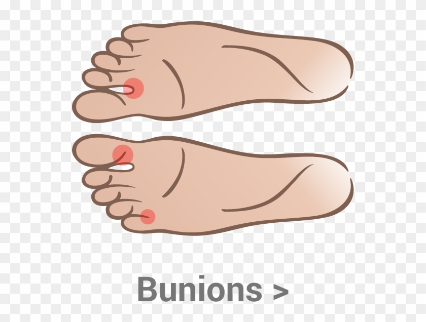 Heel-pain - Bunion On Inside Of Big Toe Clipart #889286