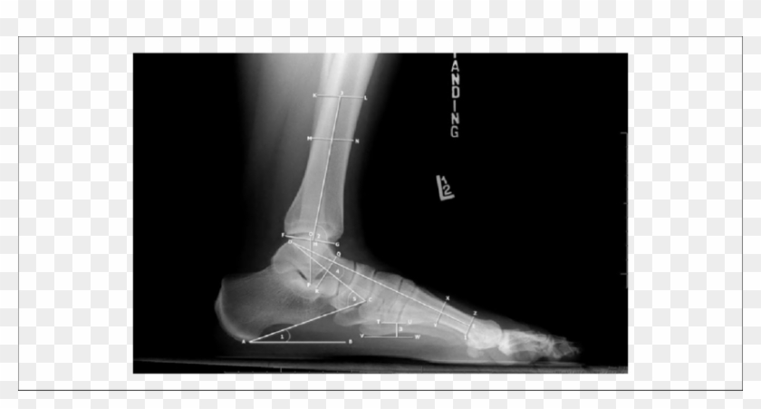 Measurements Of The Foot And Ankle On A Lateral View - Radiography Clipart
