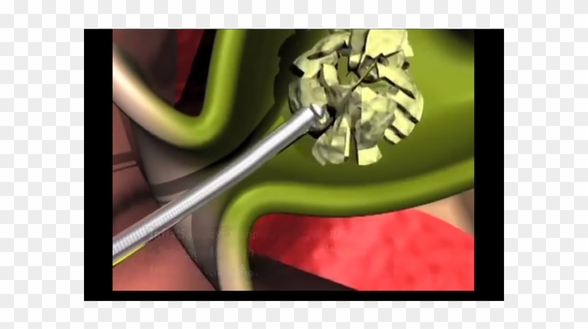 Flexible Yet Sturdy Catheter Is Designed To Bend With - Cable Clipart